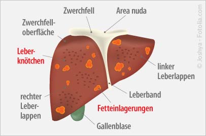 Fettleber Lebererkrankung, Was ist eine Fettleber